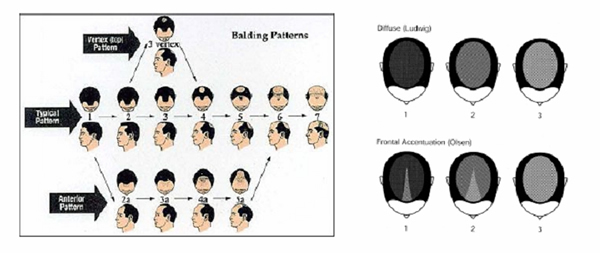 alopecia